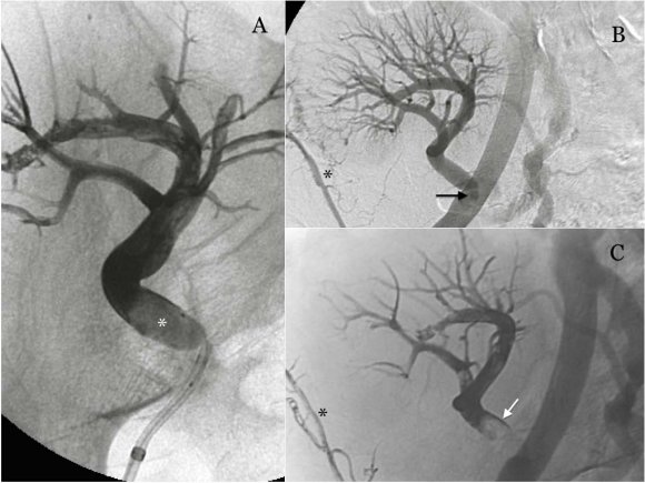 Figure 1 : A-D. Patient 1. A. Selective right renal artery angiogram demonstrates a vascularized round shaped renal tumor corresponding to a bleeding angiomyolipoma (arrow). B. Distal superselective injection through the Ascent microcatheter shows tumor vascularization. C Inflation of the ballon (black arrow) and Onyx progresion without reflux. D Final run showing normal renal vasculature and no tumor blush.