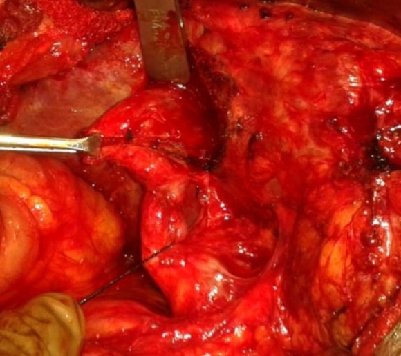 Treatment is surgical removal of cystic duct stump either by laparoscopy or by open method. Severe postoperative adhesions often require open procedure, though laparoscopic removal is feasible5,6,7 .
