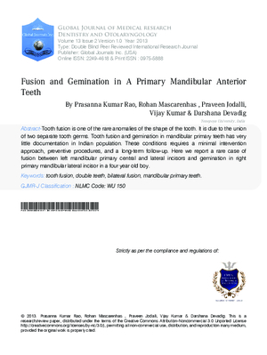 Fusion and Gemination in a Primary Mandibular Anterior Teeth