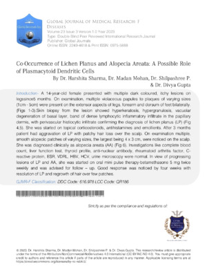 Co-Occurrence of Lichen Planus and Alopecia Areata: A Possible Role of Plasmacytoid Dendritic Cells
