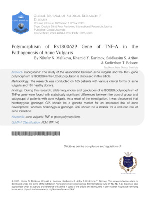 Polymorphism of Rs1800629 Gene of TNF-α in the Pathogenesis of Acne Vulgaris